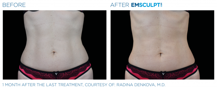 EMSCULPT NEO Before & After | Body Sculpting