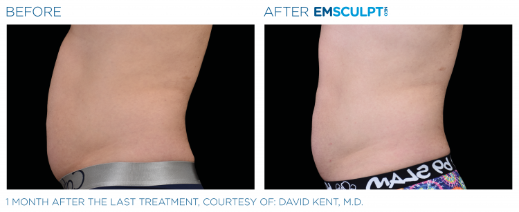 EMSCULPT NEO Before & After | Body Sculpting